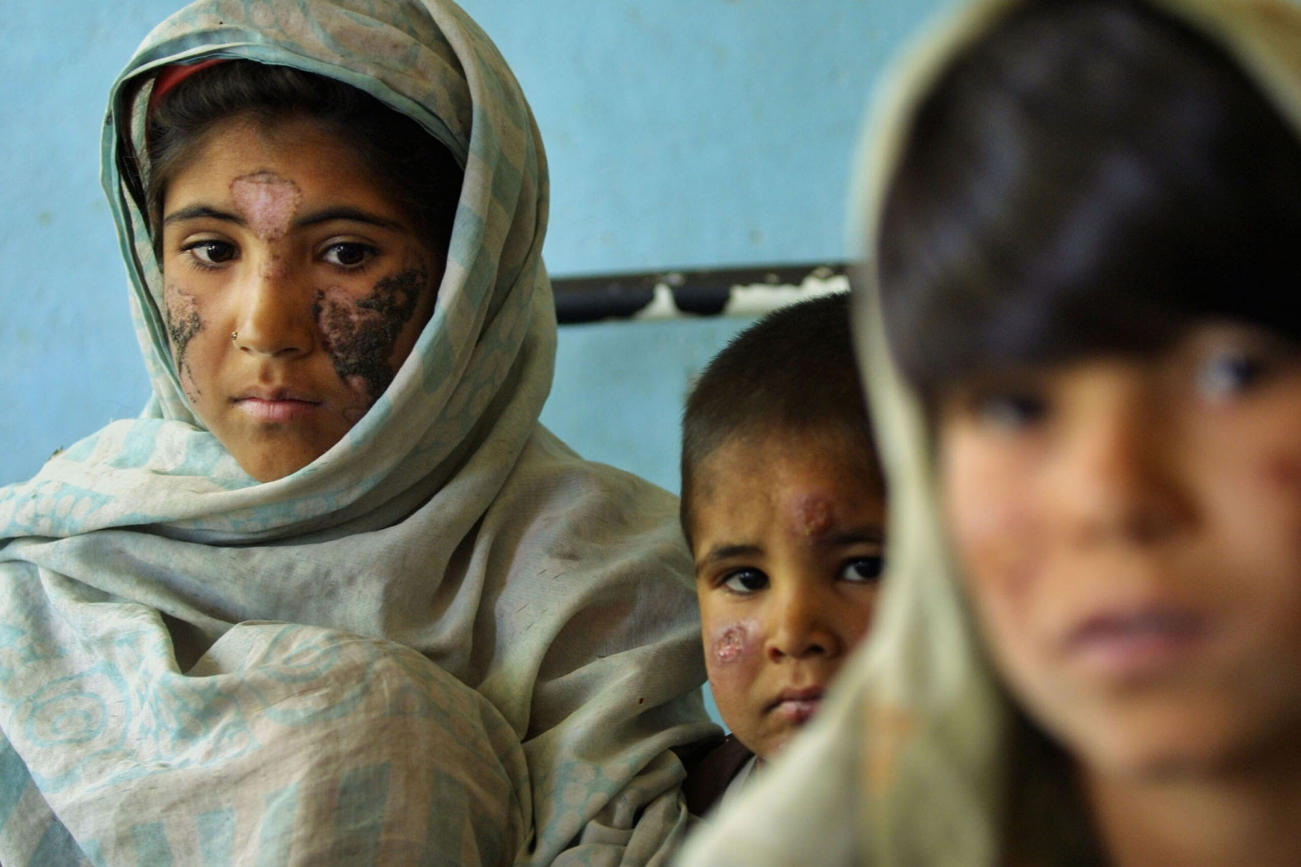 Children Suffering From Cutaneous Leishmaniasis A Disfiguring And Disabling Skin Disease